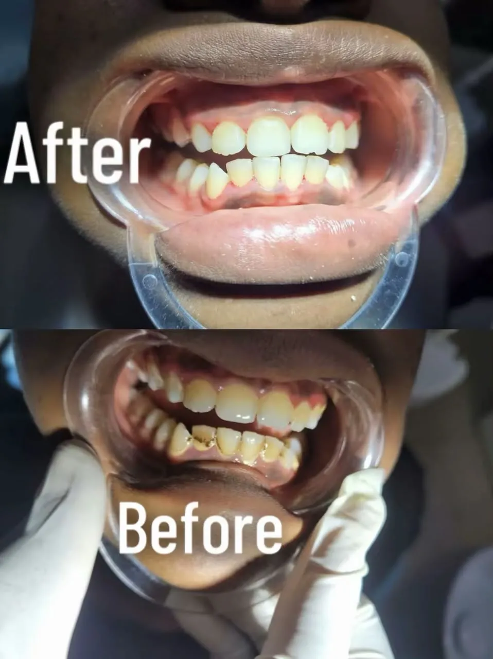 Scaling and polishing, before and after treatment