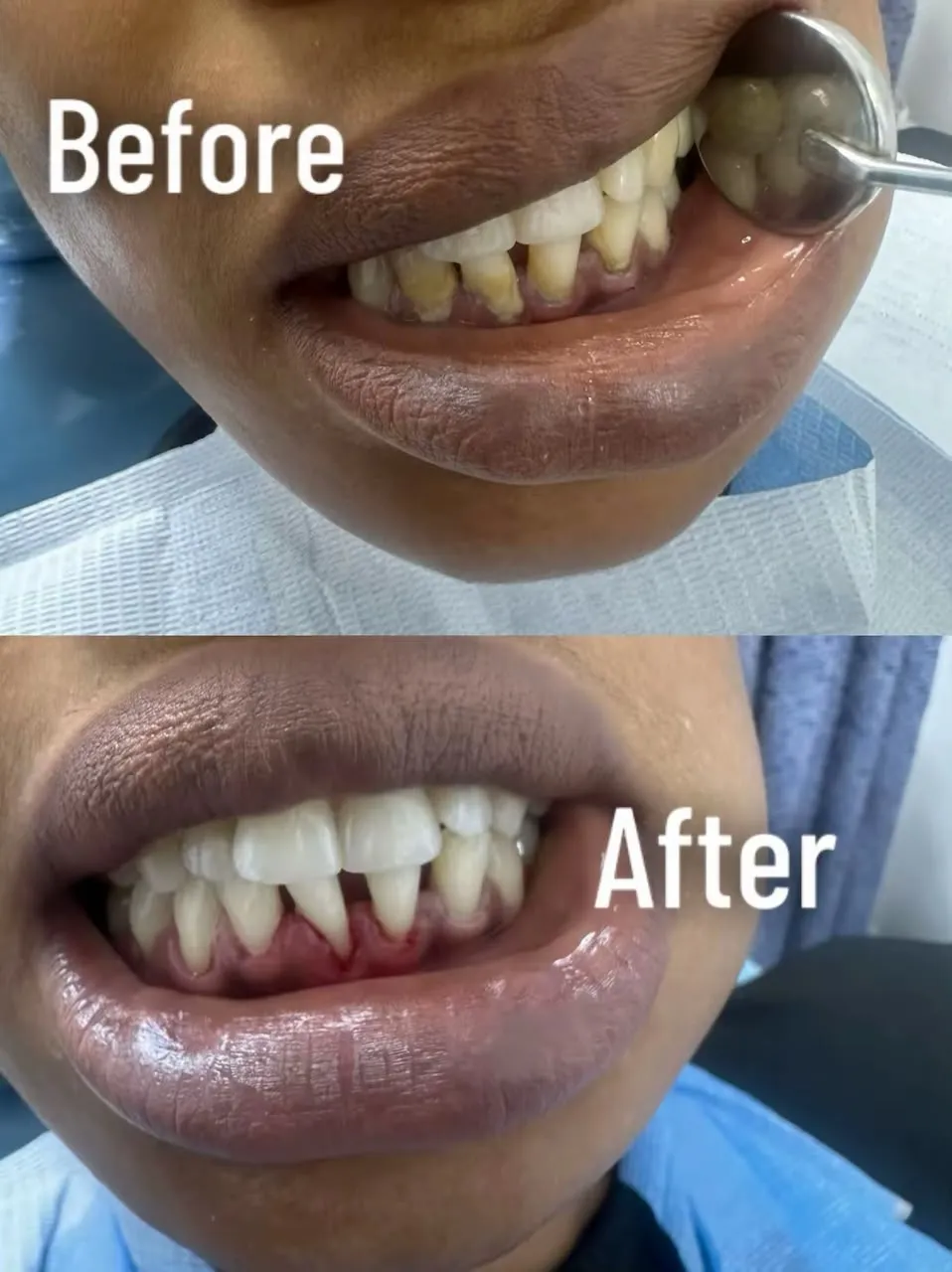 Tartar removal and gum care, before and after treatment