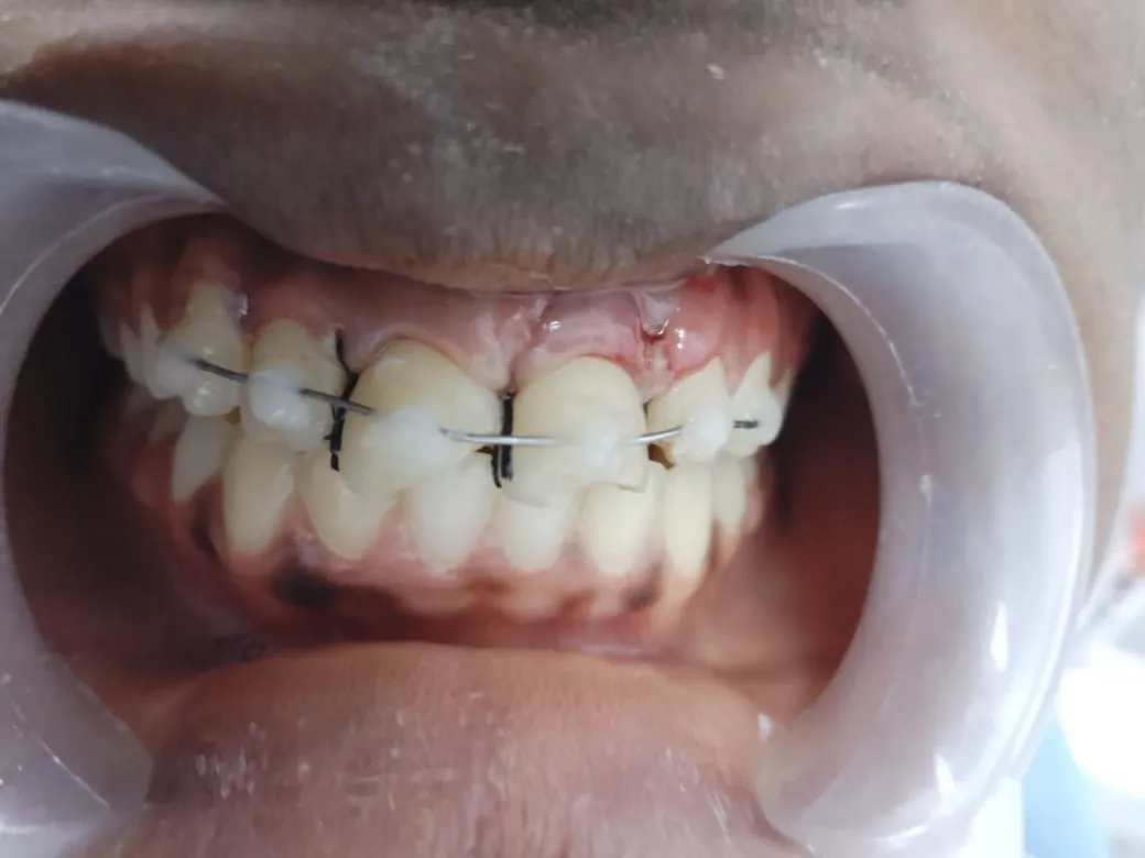 Composite wire splint of a dentoalveolar fracture, photo 1