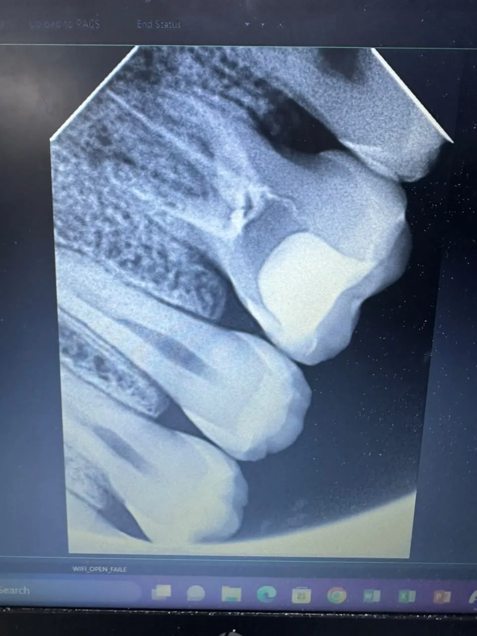 Root canal treatment, photo 1