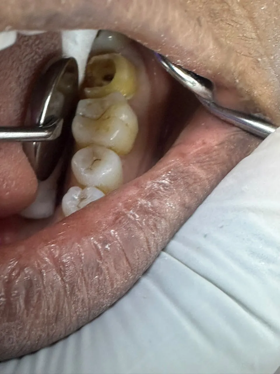Root canal treatment, photo 2