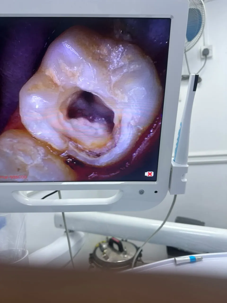 Root canal treatment, photo 3