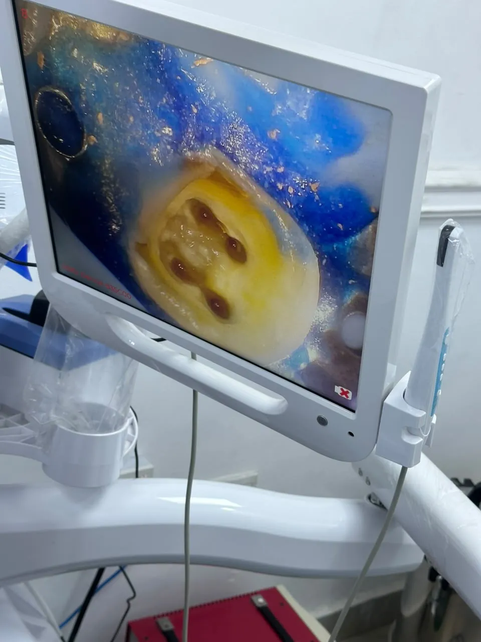 Root canal treatment, photo 4