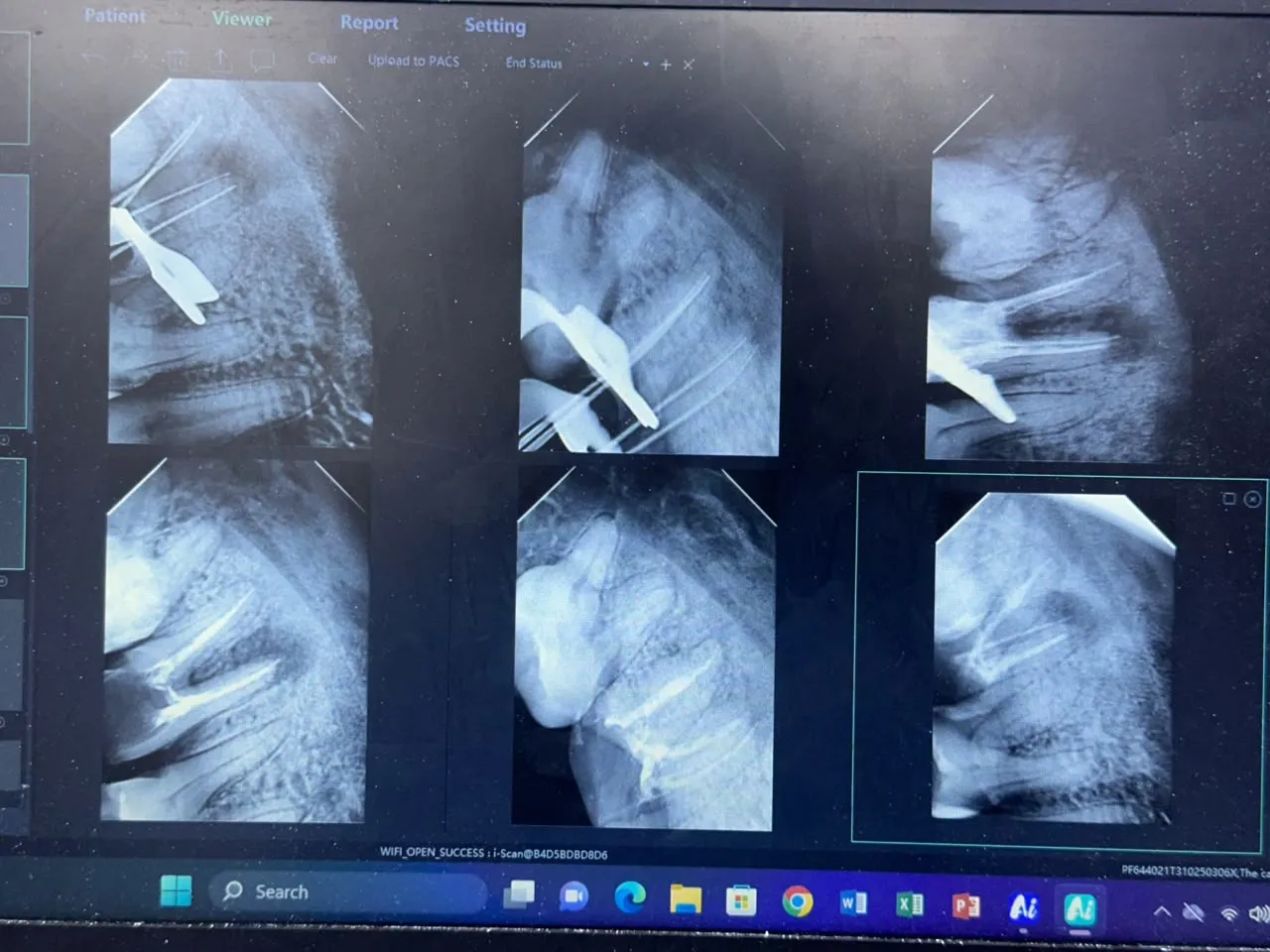 Root canal treatment, photo 5
