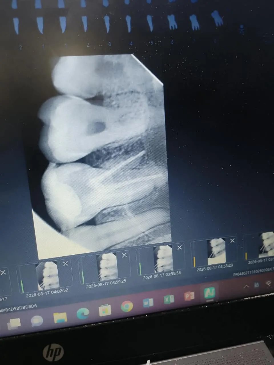 Root canal treatment, photo 6